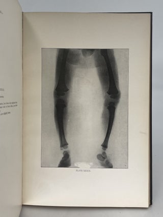 A Radiographic Atlas of the Pathologic Changes of Bones and Joints.